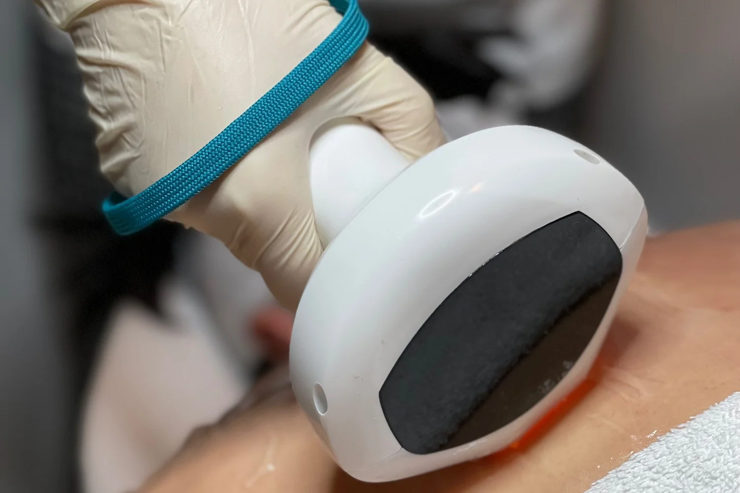 Lumecca IPL treatment at Liveo